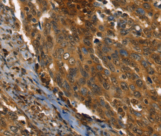 Immunohistochemistry of paraffin-embedded Human cervical cancer using PPIA Polyclonal Antibody at dilution of 1:35