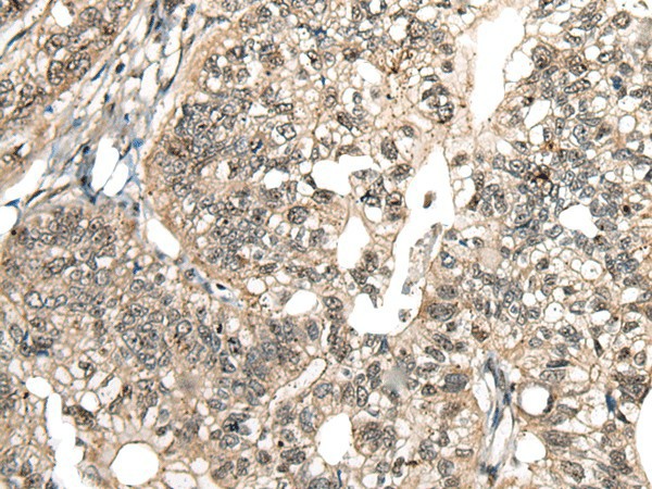 Immunohistochemistry of paraffin-embedded Human gastric cancer tissue  using MCPH1 Polyclonal Antibody at dilution of 1:110(?200)