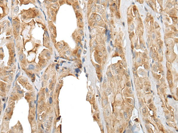 Immunohistochemistry of paraffin-embedded Human thyroid cancer tissue  using PRNP Polyclonal Antibody at dilution of 1:45(?200)