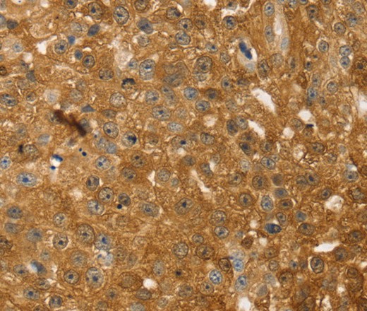 Immunohistochemistry of paraffin-embedded Human breast cancer tissue using TMSB10 Polyclonal Antibody at dilution 1:35