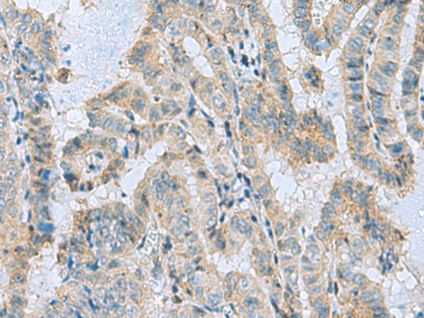 Immunohistochemistry of paraffin-embedded Human thyroid cancer tissue  using MGME1 Polyclonal Antibody at dilution of 1:50(?200)