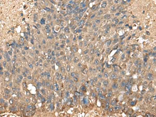 Immunohistochemistry of paraffin-embedded Human liver cancer tissue  using MRPL42 Polyclonal Antibody at dilution of 1:60(?200)