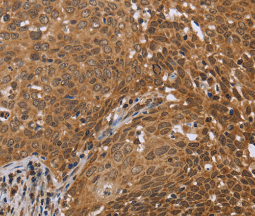 Immunohistochemistry of paraffin-embedded Human cervical cancer using FKBP8 Polyclonal Antibody at dilution of 1:50