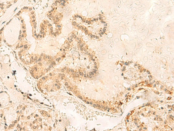 Immunohistochemistry of paraffin-embedded Human thyroid cancer tissue  using ZNF85 Polyclonal Antibody at dilution of 1:35(?200)