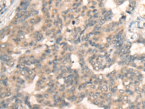 Immunohistochemistry of paraffin-embedded Human liver cancer tissue  using BBOX1 Polyclonal Antibody at dilution of 1:45(?200)