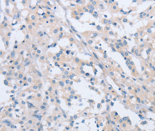 Immunohistochemistry of paraffin-embedded Human thyroid cancer tissue using AGAP2 Polyclonal Antibody at dilution 1:60