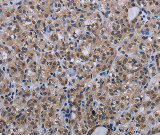 Immunohistochemistry of paraffin-embedded Human thyroid cancer tissue using MAGEC1 Polyclonal Antibody at dilution 1:30