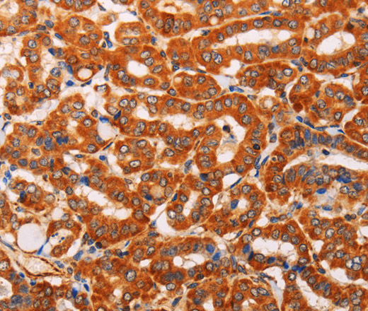 Immunohistochemistry of paraffin-embedded Human thyroid cancer using SLC25A4 Polyclonal Antibody at dilution of 1:40