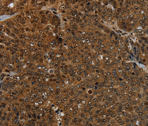 Immunohistochemistry of paraffin-embedded Human ovarian cancer tissue using KDM4B Polyclonal Antibody at dilution 1:50