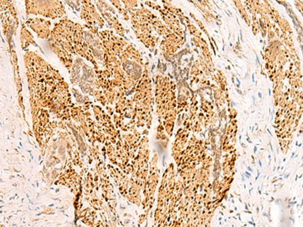 Immunohistochemistry of paraffin-embedded Human esophagus cancer tissue  using RFX6 Polyclonal Antibody at dilution of 1:50(?200)