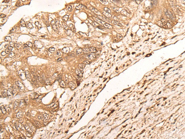 Immunohistochemistry of paraffin-embedded Human colorectal cancer tissue  using MAGEA1 Polyclonal Antibody at dilution of 1:65(?200)