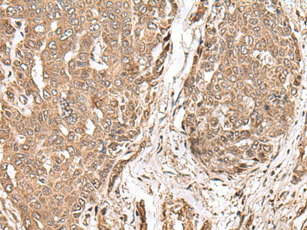 Immunohistochemistry of paraffin-embedded Human liver cancer tissue  using MAGOHB Polyclonal Antibody at dilution of 1:70(?200)