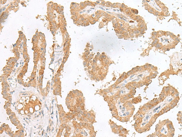 Immunohistochemistry of paraffin-embedded Human thyroid cancer tissue  using CXCL6 Polyclonal Antibody at dilution of 1:45(?200)