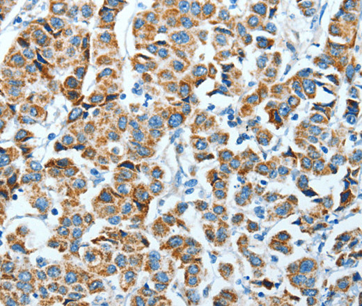 Immunohistochemistry of paraffin-embedded Human breast cancer using ALDH4A1 Polyclonal Antibody at dilution of 1:45