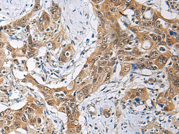 Immunohistochemistry of paraffin-embedded Human esophagus cancer tissue  using THOC3 Polyclonal Antibody at dilution of 1:85(?200)