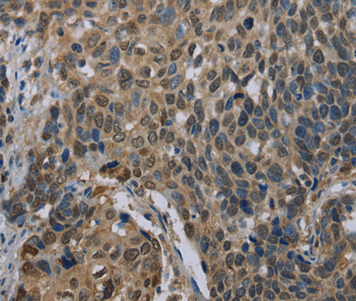 Immunohistochemistry of paraffin-embedded Human cervical cancer using UBP1 Polyclonal Antibody at dilution of 1:40