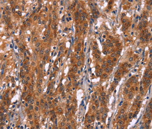 Immunohistochemistry of paraffin-embedded Human gastric cancer tissue using GPHN Polyclonal Antibody at dilution 1:30