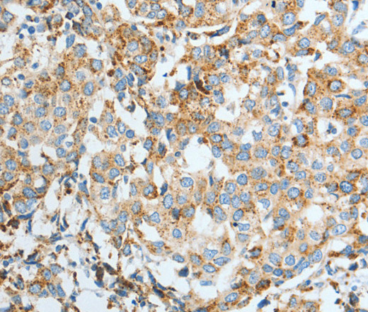 Immunohistochemistry of paraffin-embedded Human breast cancer using ASAH1 Polyclonal Antibody at dilution of 1:50