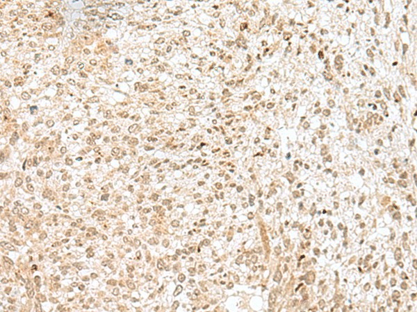 Immunohistochemistry of paraffin-embedded Human liver cancer tissue  using NGEF Polyclonal Antibody at dilution of 1:35(?200)