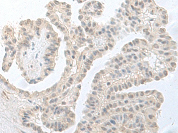 Immunohistochemistry of paraffin-embedded Human thyroid cancer tissue  using RPS27L Polyclonal Antibody at dilution of 1:55(?200)