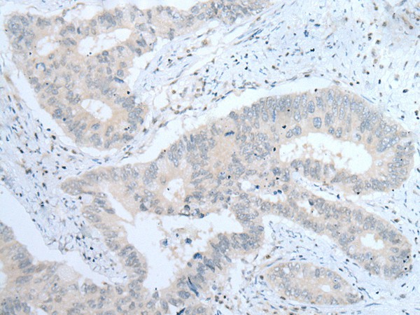 Immunohistochemistry of paraffin-embedded Human colorectal cancer tissue  using ITGA8 Polyclonal Antibody at dilution of 1:30(?200)