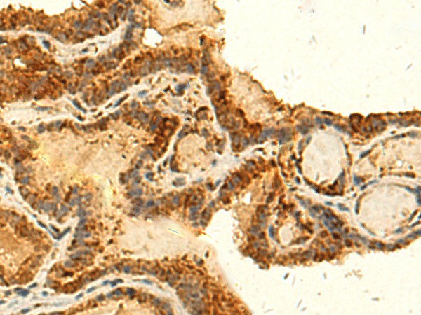 Immunohistochemistry of paraffin-embedded Human thyroid cancer tissue  using HS1BP3 Polyclonal Antibody at dilution of 1:50(?200)