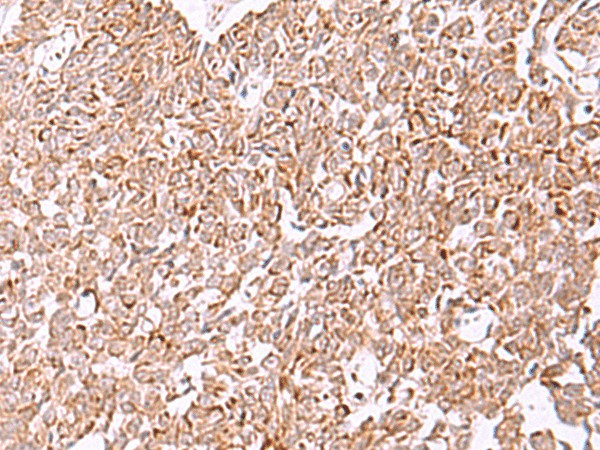 Immunohistochemistry of paraffin-embedded Human ovarian cancer tissue  using IRX2 Polyclonal Antibody at dilution of 1:45(?200)