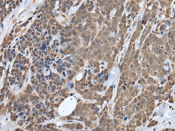 Immunohistochemistry of paraffin-embedded Human thyroid cancer tissue  using ZNF410 Polyclonal Antibody at dilution of 1:40(?200)