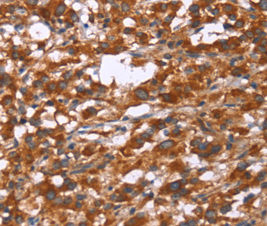 Immunohistochemistry of paraffin-embedded Human thyroid cancer tissue using GPHN Polyclonal Antibody at dilution 1:30