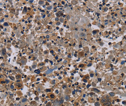 Immunohistochemistry of paraffin-embedded Human lung cancer using NECTIN4 Polyclonal Antibody at dilution of 1:60