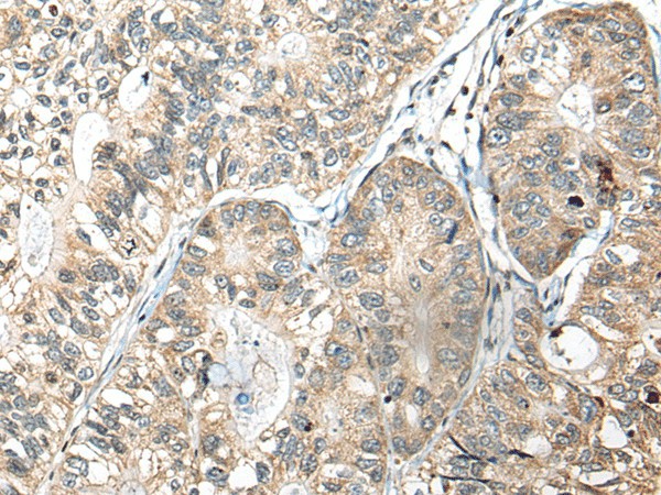 Immunohistochemistry of paraffin-embedded Human gastric cancer tissue  using SLAMF7 Polyclonal Antibody at dilution of 1:30(?200)