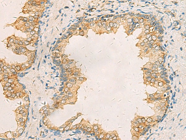 Immunohistochemistry of paraffin-embedded Human prost ate cancer tissue  using AIMP1 Polyclonal Antibody at dilution of 1:40(?200)