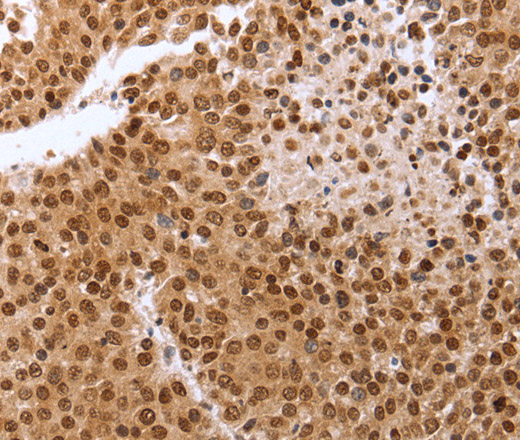 Immunohistochemistry of paraffin-embedded Human breast cancer tissue using PTTG1 Polyclonal Antibody at dilution 1:60