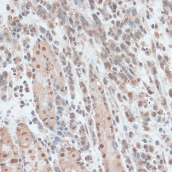 Immunohistochemistry of paraffin-embedded Human gastric cancer using ZNF562 Polyclonal Antibody at dilution of  1:100 (40x lens).