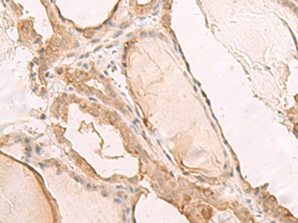 Immunohistochemistry of paraffin-embedded Human thyroid cancer tissue  using PBXIP1 Polyclonal Antibody at dilution of 1:40(?200)