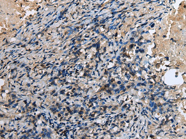 Immunohistochemistry of paraffin-embedded Human lung cancer tissue  using ABHD14B Polyclonal Antibody at dilution of 1:30(?200)