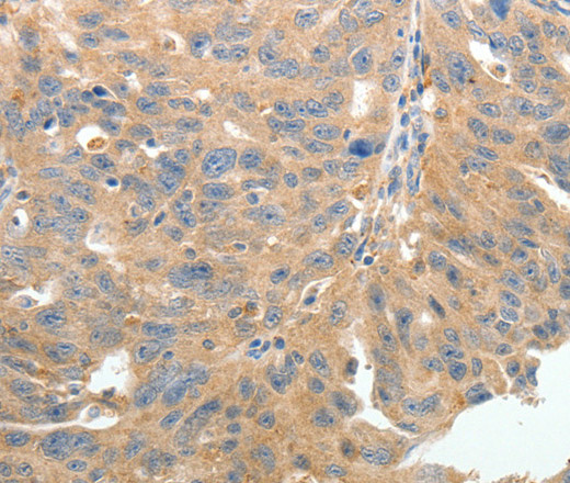 Immunohistochemistry of paraffin-embedded Human ovarian cancer tissue using TERT Polyclonal Antibody at dilution 1:50