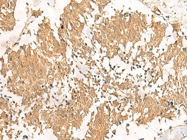 Immunohistochemistry of paraffin-embedded Human lung cancer tissue  using MTHFD2L Polyclonal Antibody at dilution of 1:30(?200)