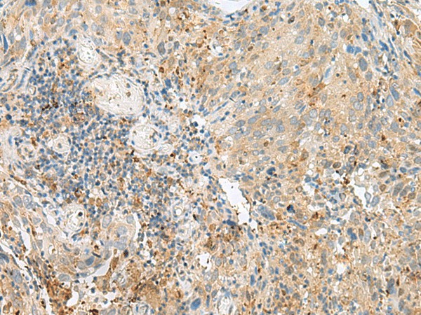 Immunohistochemistry of paraffin-embedded Human cervical cancer tissue  using CNPY3 Polyclonal Antibody at dilution of 1:55(?200)