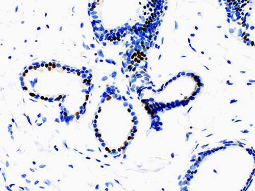 Immunohistochemistry of paraffinembedded Human breast cancer tissue with Estrogen Receptor α (ER) Monoclonal Antibody (Antigen repaired by EDTA).