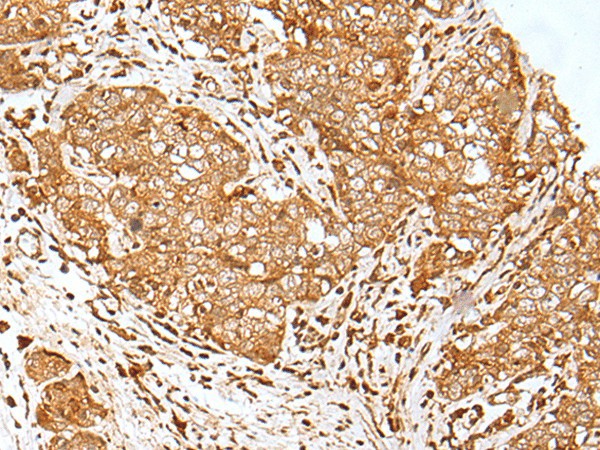 Immunohistochemistry of paraffin-embedded Human esophagus cancer tissue  using MORF4L1 Polyclonal Antibody at dilution of 1:30(?200)