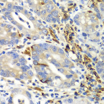 Immunohistochemistry of paraffin-embedded human gastric cancer using AIMP1 Polyclonal antibody at dilution of 1:100 (40x lens).Perform microwave antigen retrieval with 10 mM PBS buffer pH 7.2 before commencing with IHC staining protocol.