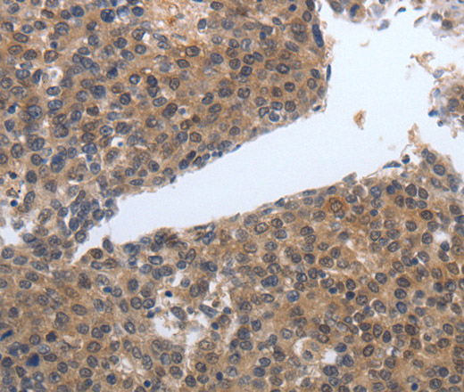 Immunohistochemistry of paraffin-embedded Human liver cancer tissue using PDGFB Polyclonal Antibody at dilution 1:40