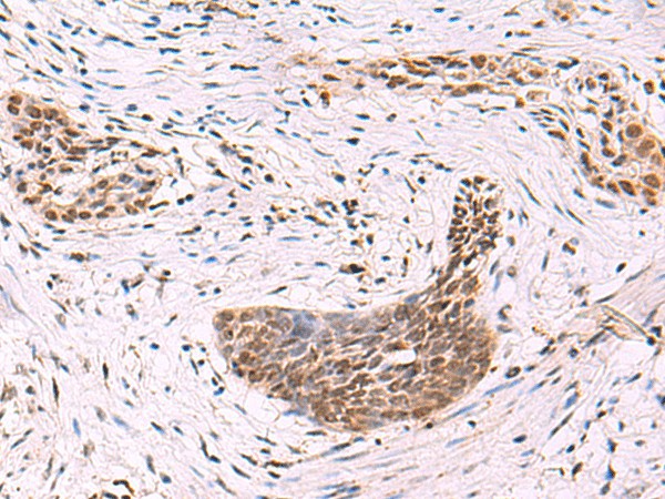 Immunohistochemistry of paraffin-embedded Human esophagus cancer tissue  using CREBBP Polyclonal Antibody at dilution of 1:35(?200)