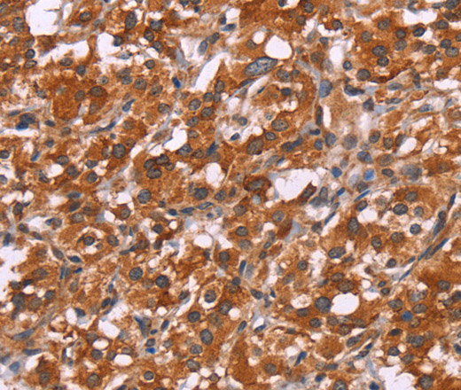 Immunohistochemistry of paraffin-embedded Human thyroid cancer tissue using HSPB6 Polyclonal Antibody at dilution 1:30