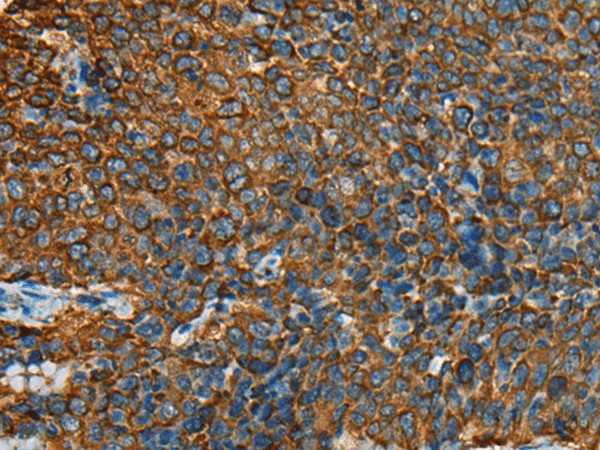 Immunohistochemistry of paraffin-embedded Human cervical cancer tissue  using YBX1 Polyclonal Antibody at dilution of 1:25(?200)