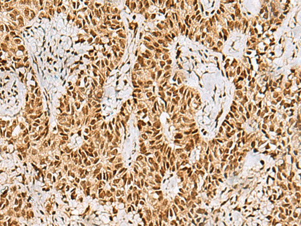 Immunohistochemistry of paraffin-embedded Human ovarian cancer tissue  using PHF5A Polyclonal Antibody at dilution of 1:55(?200)