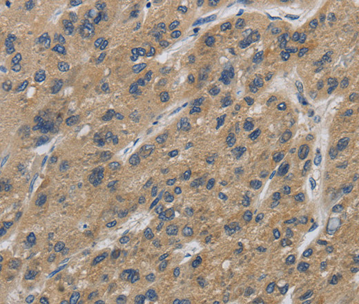 Immunohistochemistry of paraffin-embedded Human liver cancer using IPO7 Polyclonal Antibody at dilution of 1:40