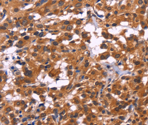 Immunohistochemistry of paraffin-embedded Human thyroid cancer tissue using MSH4 Polyclonal Antibody at dilution 1:30