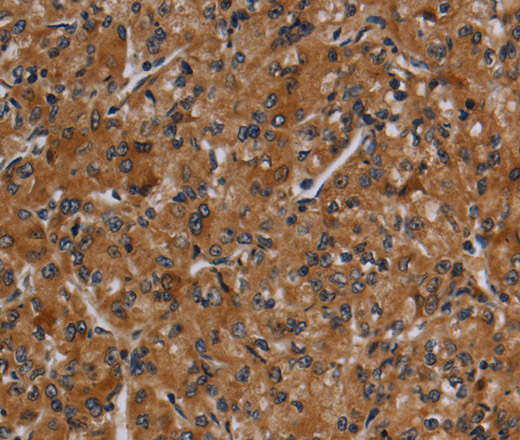 Immunohistochemistry of paraffin-embedded Human prostate cancer using CYP1A2 Polyclonal Antibody at dilution of 1:40